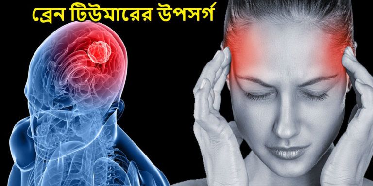 Brain Tumor: ব্রেন টিউমার সম্পর্কে কিছু অজানা তথ্য — ব্রেন টিউমারের লক্ষণ ও চিকিৎসা	