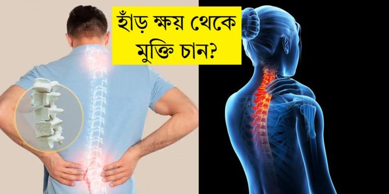 Osteoporosis: হাঁড় ক্ষয় থেকে মুক্তি পেতে চান? মেনে চলুন এই উপায়গুলি	