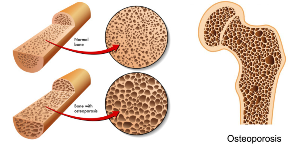 হাঁড় ক্ষয় / Osteoporosis