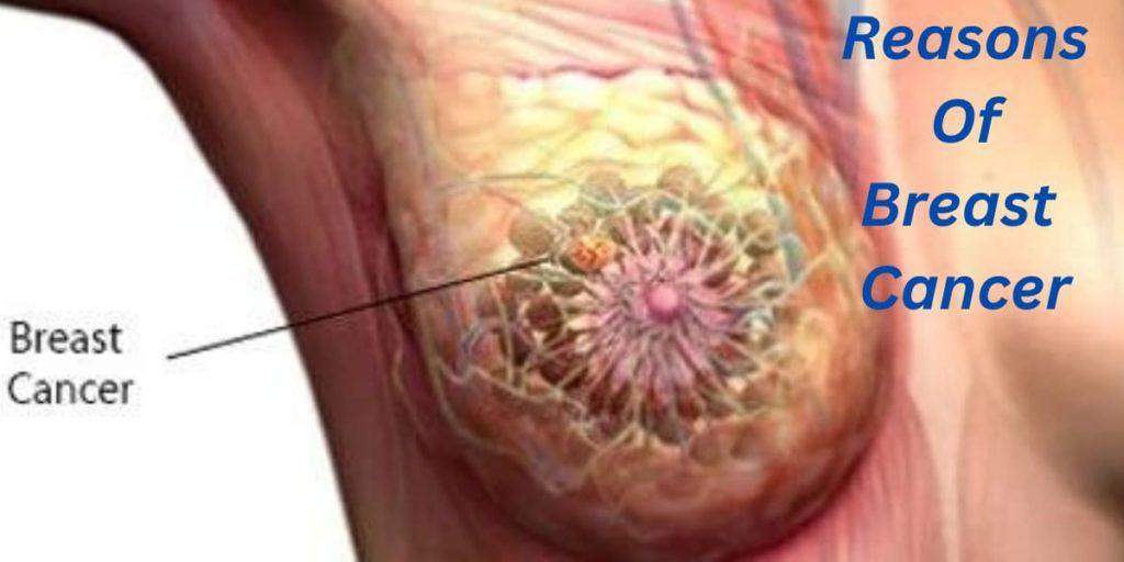 স্তন ক্যান্সারের কারণগুলি - Breast Cancer Causes