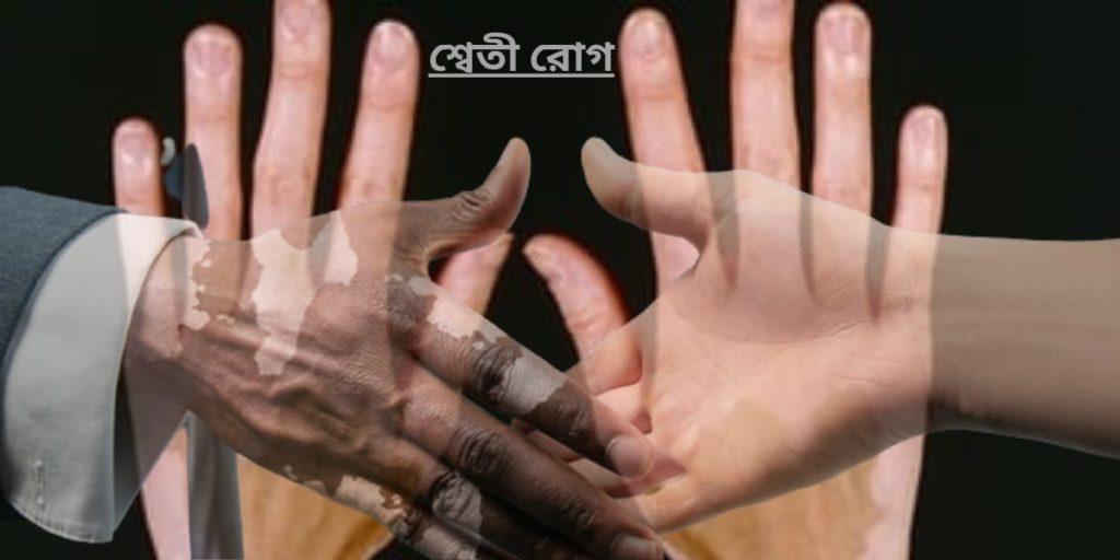 শ্বেতী রোগের চিকিৎসা - Vitiligo Treatment
