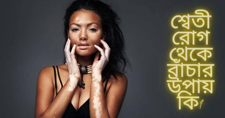 Vitiligo Treatment: ‘শ্বেতি’ রোগ কিভাবে আটকাবেন ও কি চিকিৎসা করাবেন?	