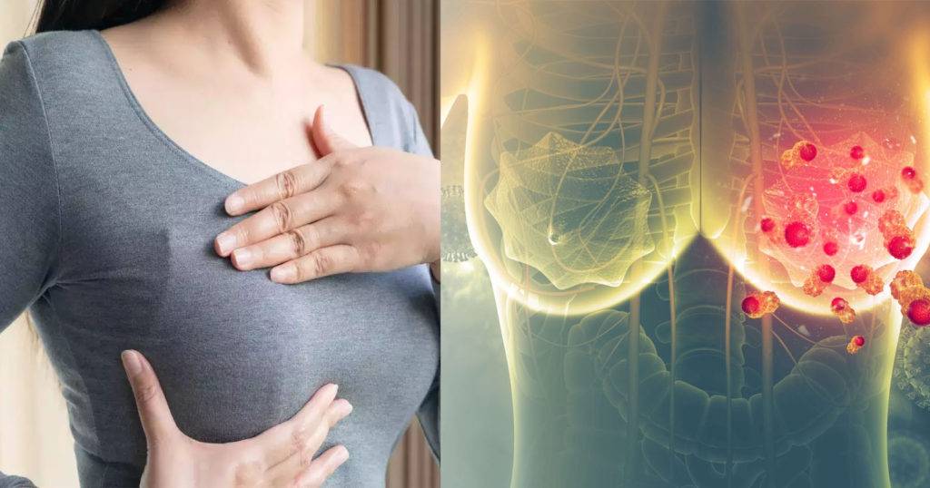 স্তন ক্যান্সারের কারণগুলি - Breast Cancer Causes