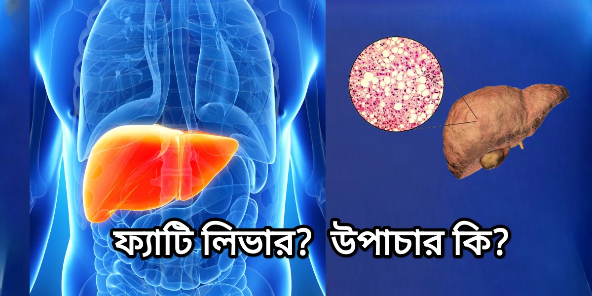 ফ্যাটি লিভারের কোনো বিশেষ চিকিৎসা হয় না। তবে, সেরে উঠতে অবশ্যই মেনে চলতে হবে কয়েকটি নিয়ম। / There is no specific treatment for fatty liver. However, there are a few rules that must be followed in order to recover.