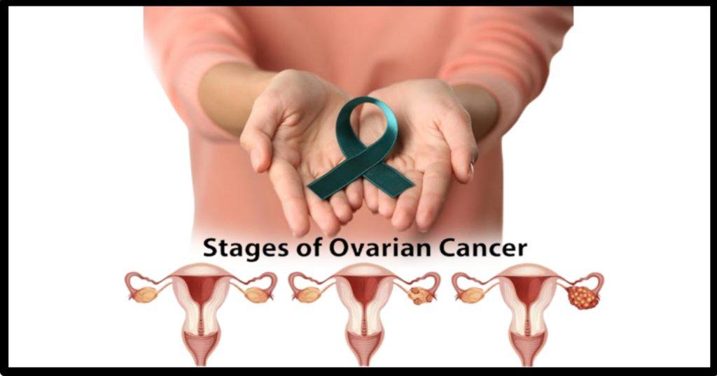 Ovarian Cancer can spread to the other parts of the body in stages / ওভারিয়ান ক্যান্সার ধাপে ধাপে শরীরে ছড়িয়ে পড়তে পারে