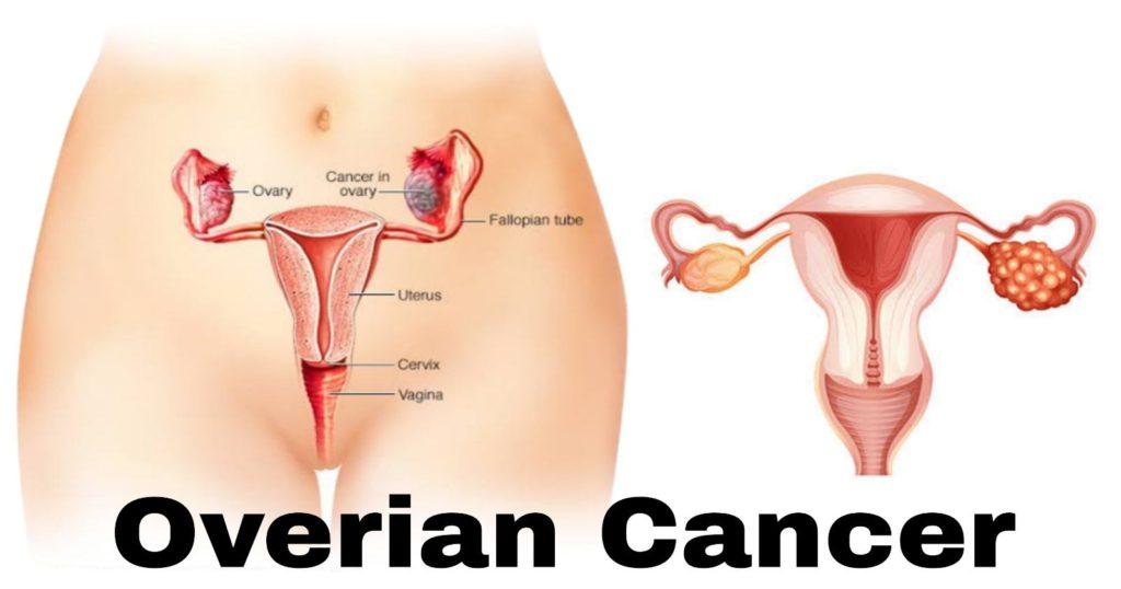 Ovarian Cancer symptoms and treatment