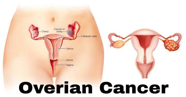 Ovarian Cancer: ওভারিয়ান ক্যান্সার শনাক্তকরণ ও প্রতিকারের উপায়	
